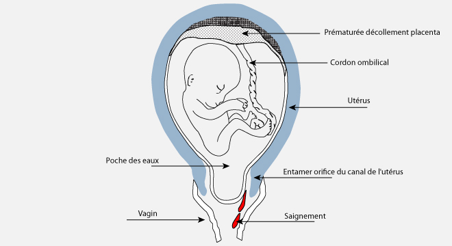 Avortement, Fausse couche