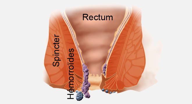 Hémorroïdes : symptômes, traitement, définition 