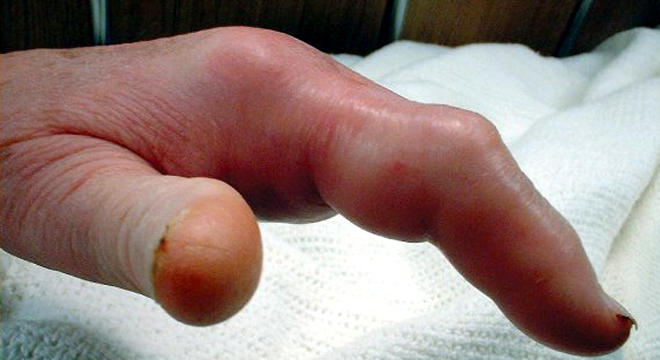 Infections de la main, Panaris, Paronychie, Phlegmon