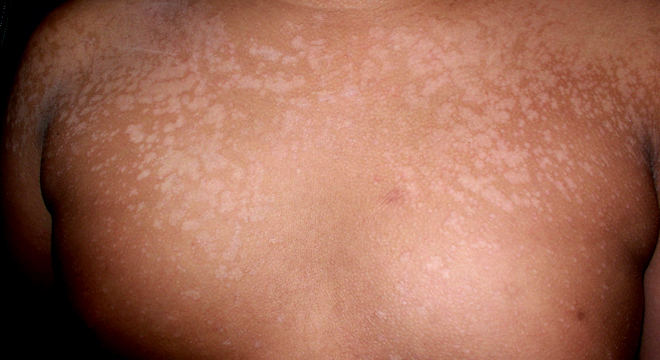 Pityriasis versicolor