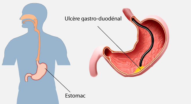 Ulcère gastrique, Ulcère duodénal