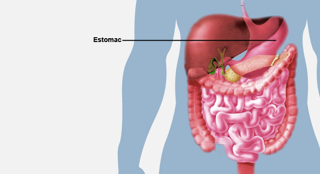 Cancer de l'estomac