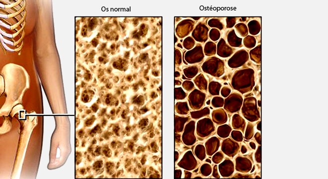 Ostéoporose : comprendre l'anatomie des os