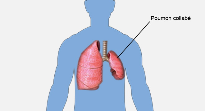 Pneumothorax, Collapsus pulmonaire, Pneumothorax sous tension