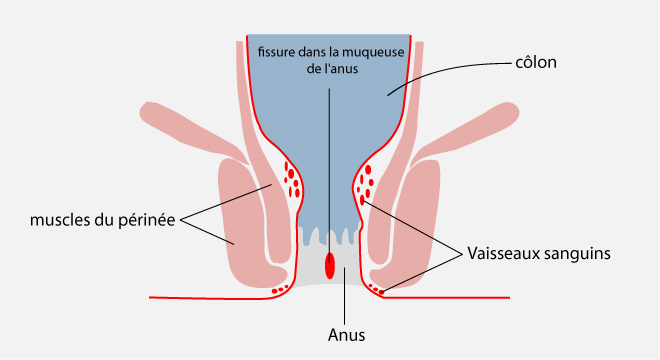 Fissure anale