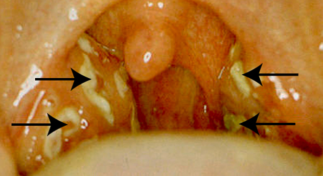 Angine, Amygdalite, Inflammation des amygdales