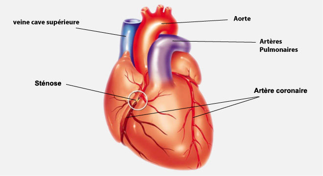 Angine de poitrine, Constriction thoracique