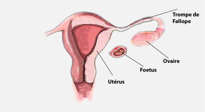 Grossesse péritonéale, Grossesse abdominale