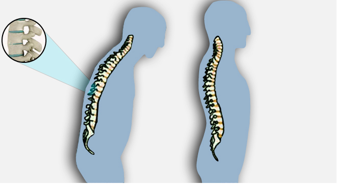 Spondylarthrite ankylosante, Maladie de Bechterew, Pelvispondylite ...