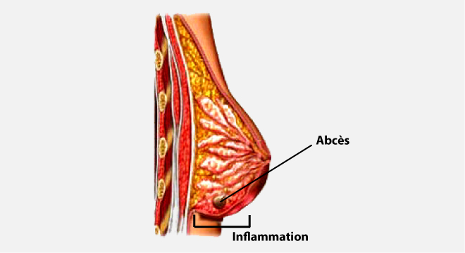 Inflammation des seins, Mastite