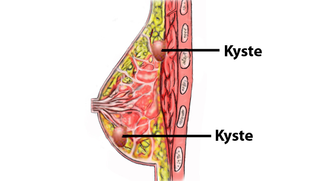 Les différents types de kystes mammaires - Symptômes, Diagnostic &  Traitements