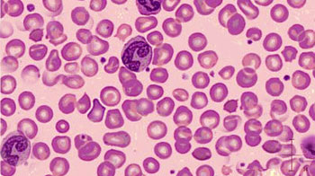 L’anémie ferriprive s’observe au niveau des globules rouges
