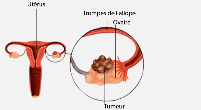 Cancer de l'ovaire, Cancer ovarien