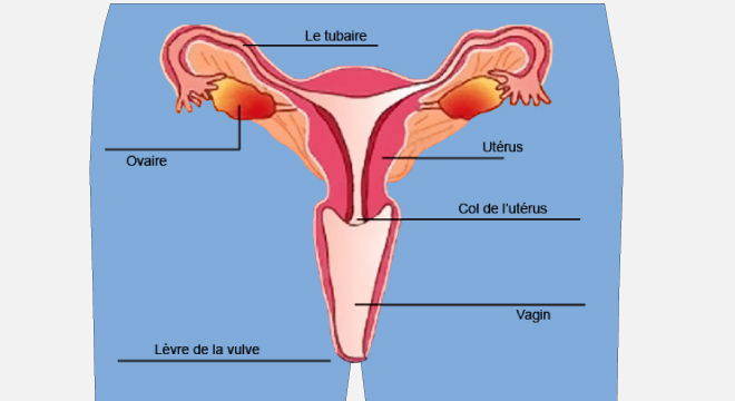 Cancer du col de l`utérus, Carcinome cervical