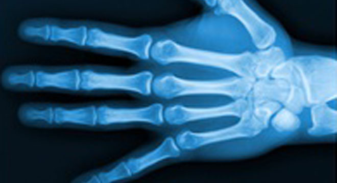 Fracture du poignet, de l'avant-bras, du radius et de l'ulna