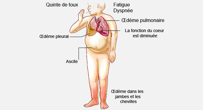 Insuffisance cardiaque