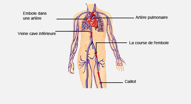 Embolie pulmonaire, Thromboses veineuses des jambes