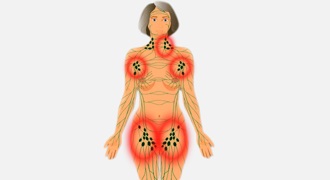 Lymphome, Cancer des ganglions lymphatiques, Lymphome non ...