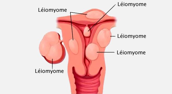 Myome de l`utérus