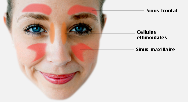 Inflammation des sinus (sinusite)