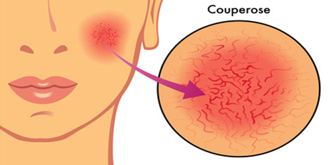 Rosacée, Acne rosacea, Couperose