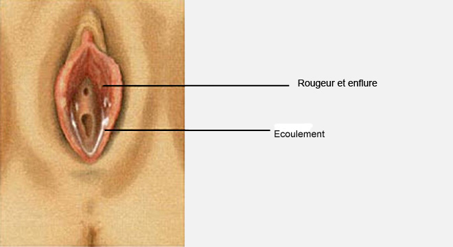 Vaginite : Causes, symptômes et traitement