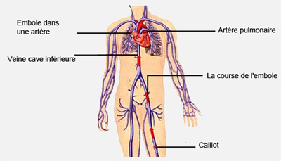 Symptômes de l'hypercoagulabilité