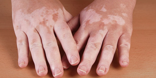 Vitiligo