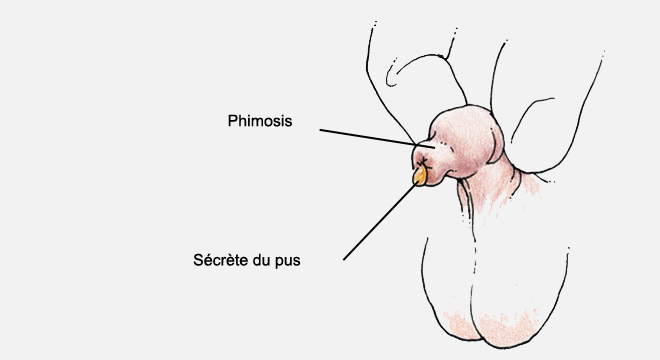 3 manières de traiter le phimosis grâce à des étirements du prépuce